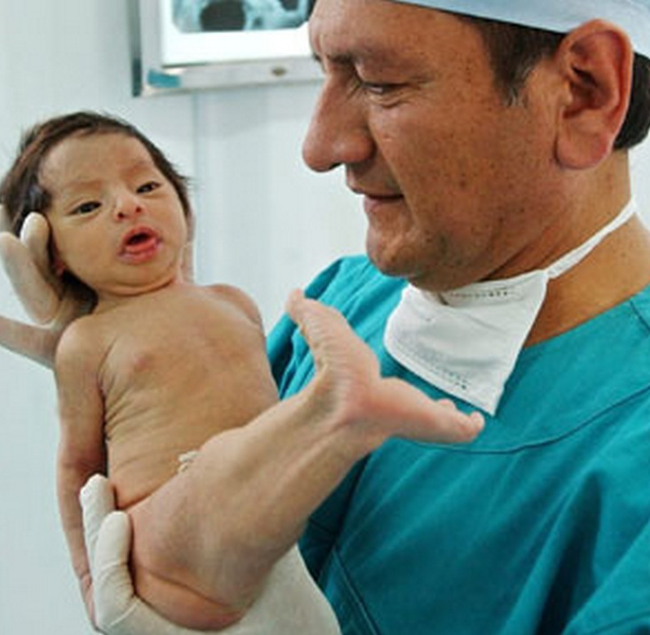 Sirenomelie (Meerjungfrauensyndrom): Was ist das, Symptome, Fotos, Behandlung, Prognose