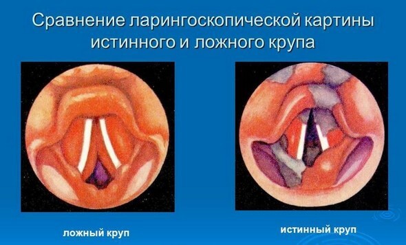 Pseudocroup: Symptome und Behandlung