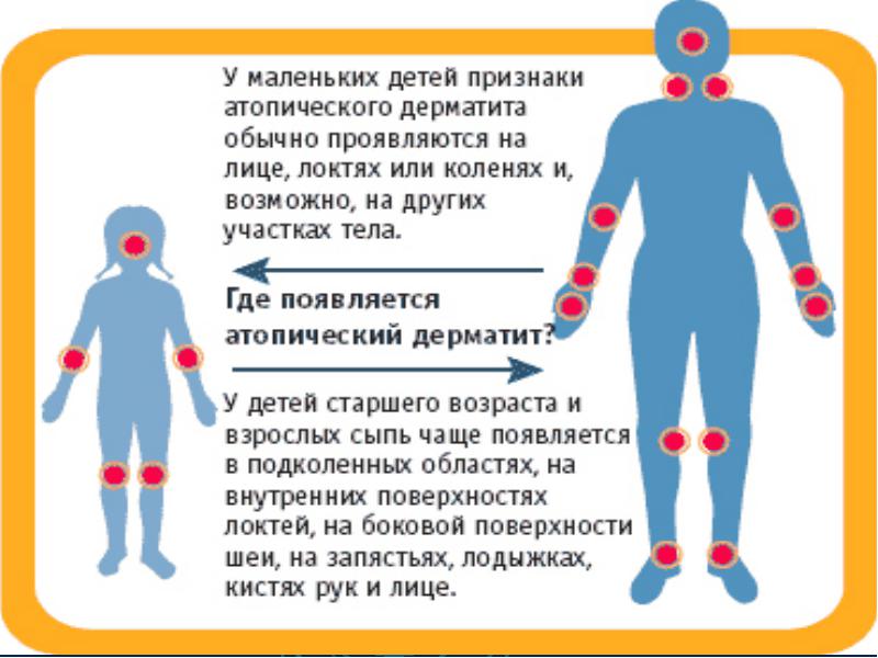 Atopic dermatitis in children: causes, manifestations and principles of treatment