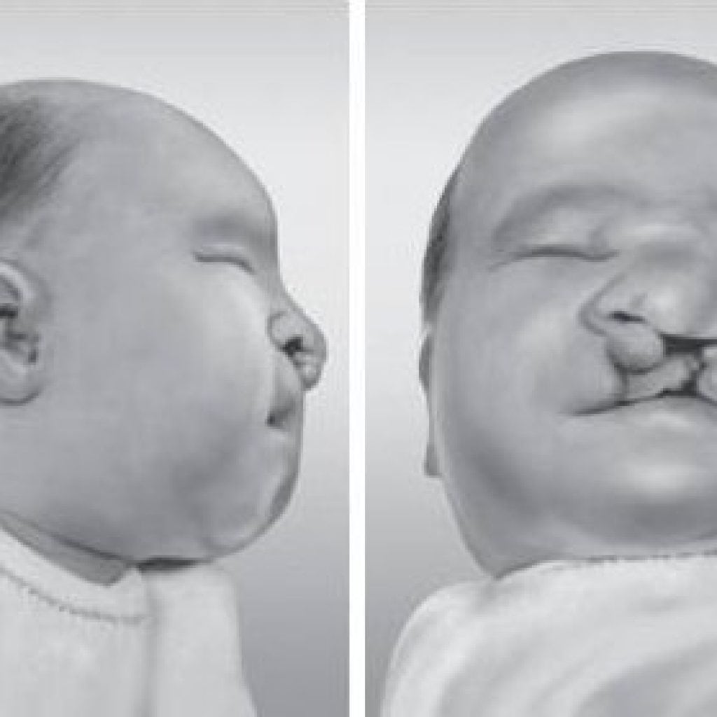 Patauův syndrom: fotografie, příznaky, co to je, jak dlouho žijí