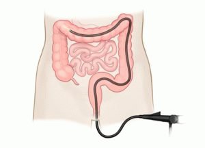 Pseudomembranøs colitis: symptomer og behandling af sygdommen