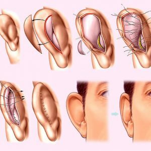 Deformasjon av ører og otoplasty