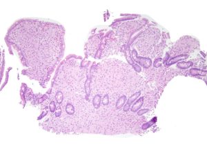 Krankheit Enteritis