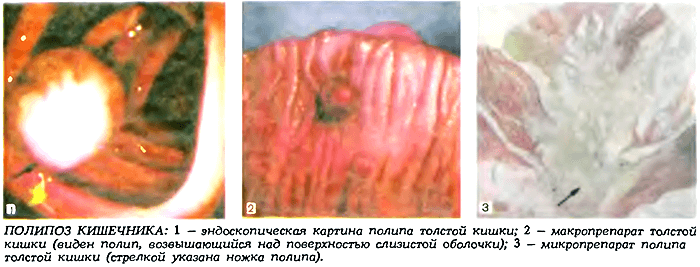 Benign tumors of the large intestine: symptoms, removal, prognosis and possible risks