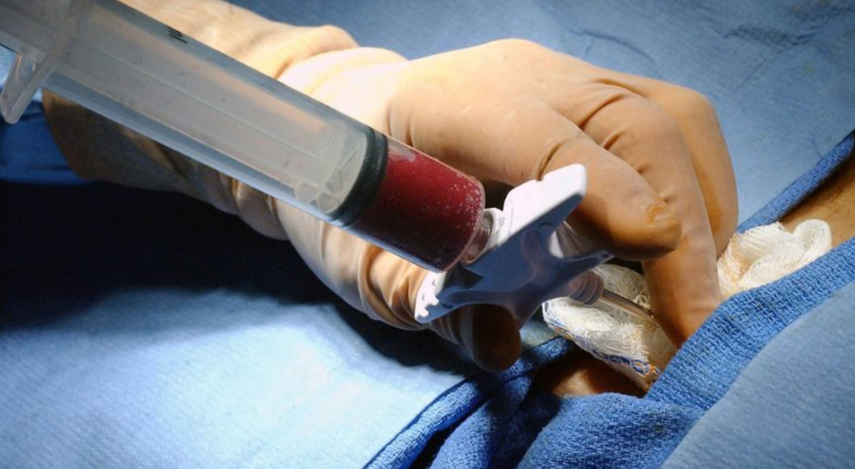 Hidrocele en los hombres y los muchachos: síntomas, diagnóstico y tratamiento