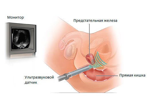 L'échographie de la prostate: la formation, la lecture, les procédures