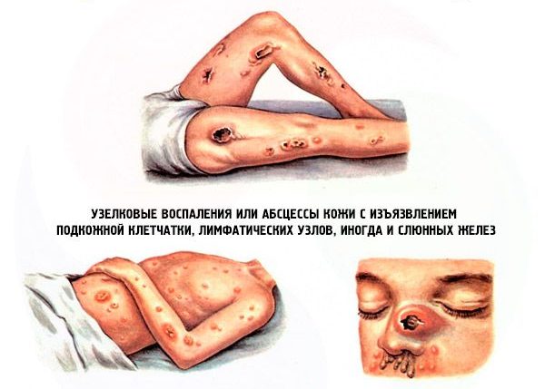 Melioidose: Was ist das, Ursachen, Symptome, Behandlung, Prognose