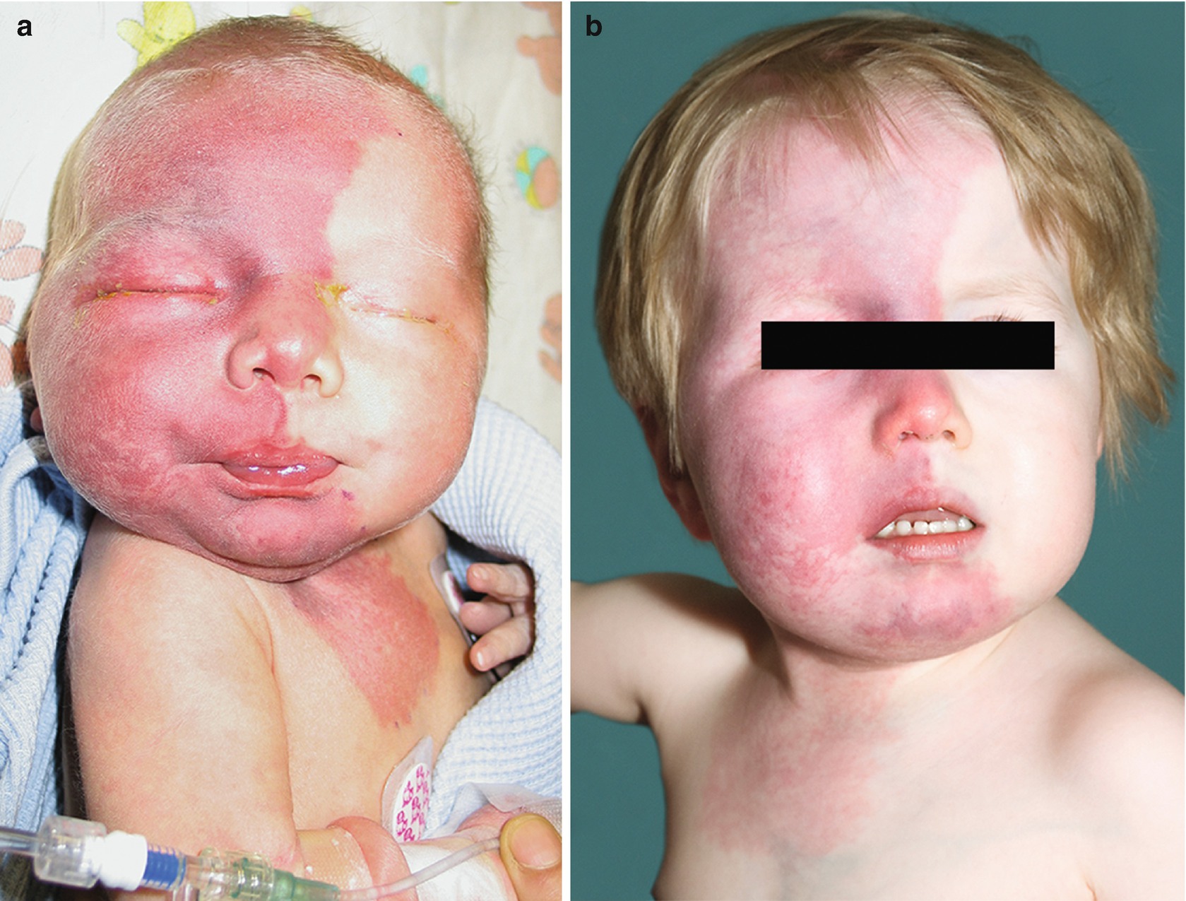 Sturge-Weber-syndroom: wat is het, symptomen, behandeling, prognose?