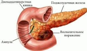 Kaip atkurti kasą sergant lėtiniu pankreatitu