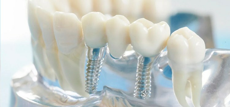 Kontrindikācijas zobu implantācijai