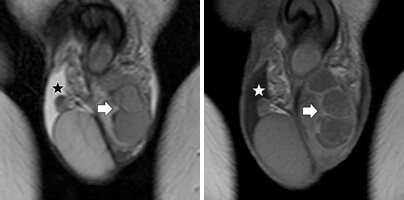 Scrotal abscess: årsaker, symptomer, diagnostikk og behandlinger