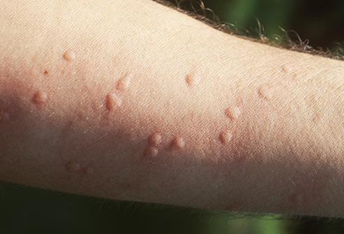 Allergische Reaktionen: Was ist das, Symptome, Ursachen, Behandlung