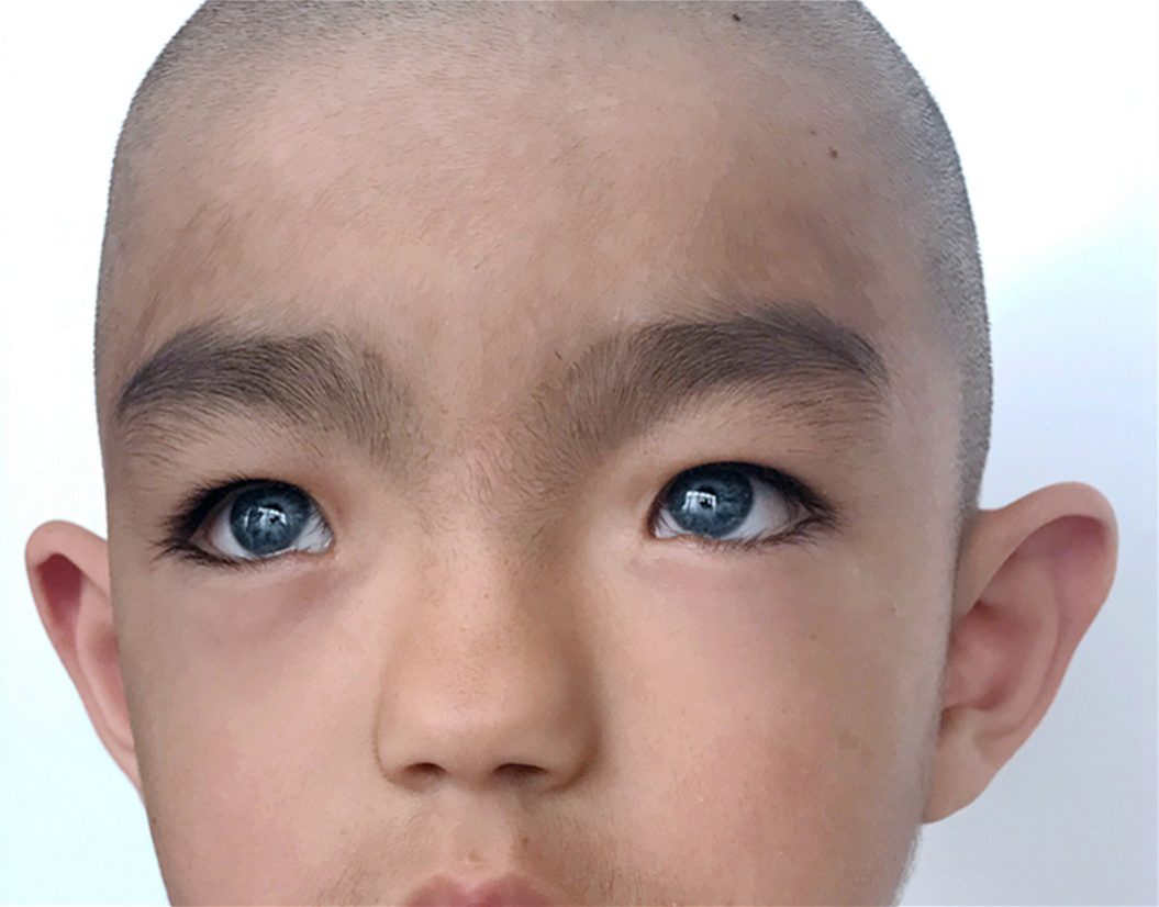 Waardenburg-Syndrom: Was ist das, Symptome, Behandlung, Prognose