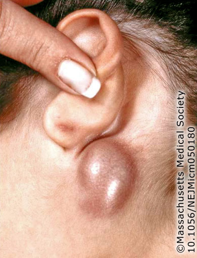 Bartonellose: Was ist das, Symptome, Ursachen, Behandlung, Prognose