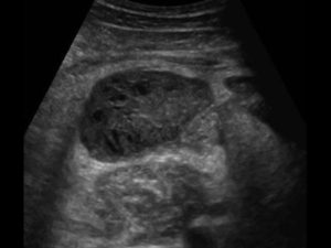 Grüner Durchfall bei einem Kind, Baby: Ursachen und schnelle Behandlung
