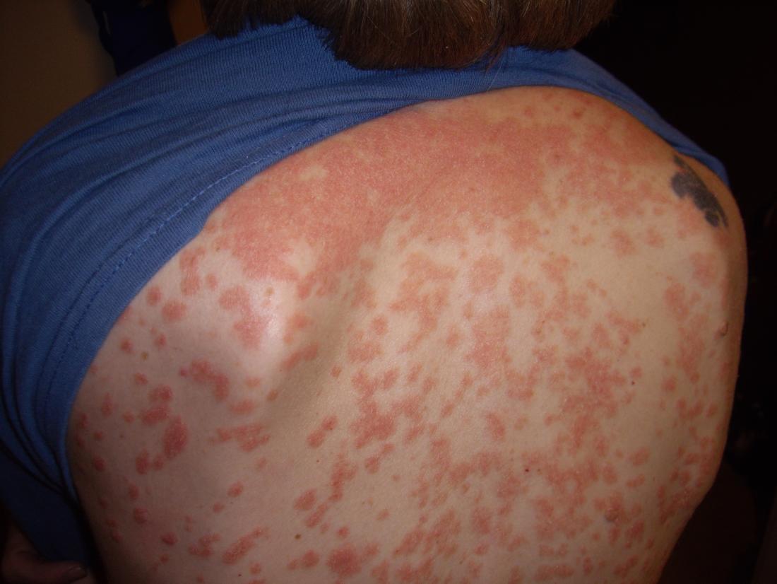 Psoriasis guttata: Was ist das, Symptome, Behandlung, Prognose?