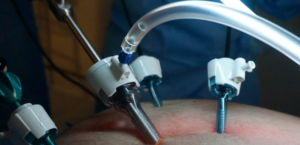 Appendicectomia: intervento chirurgico per rimuovere l'appendicite, metodi, preparazione
