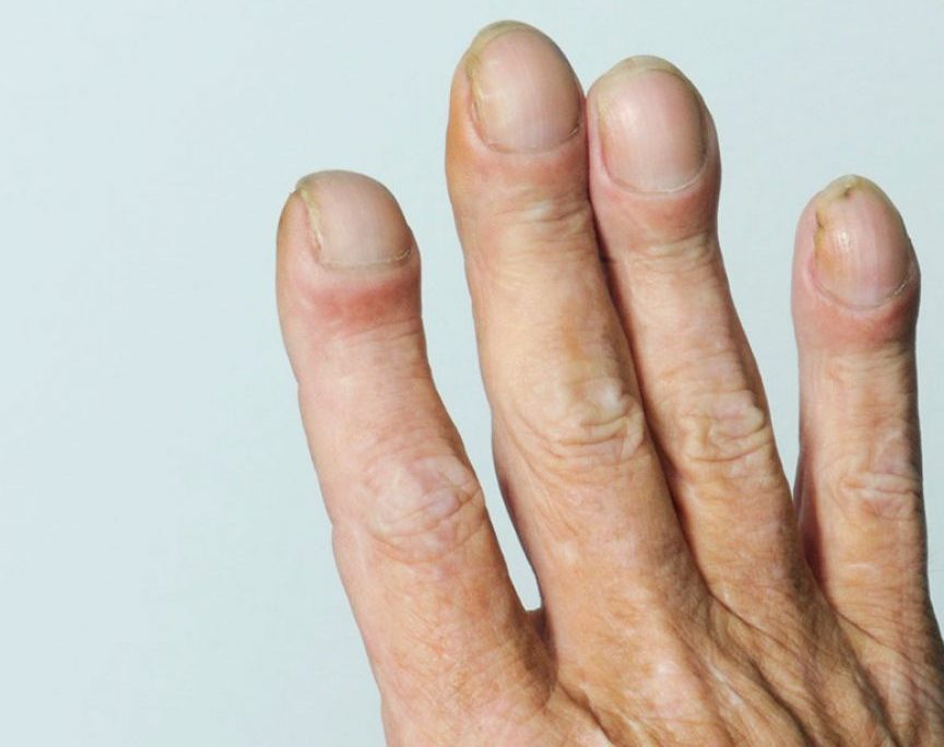 Interstitielle Lungenerkrankung: Was ist das, Symptome, Behandlung, Prognose