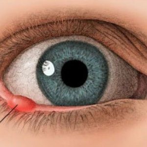 Kook aan het oog: behandeling
