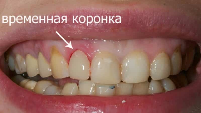 Ideiglenes koronák az első fogak, és hány fotókat lehet viselni