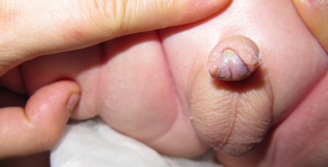 Hypospadie: Arten, Ursachen, Behandlung