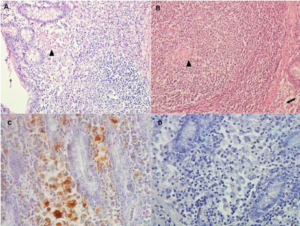 Granulomatöse Enteritis