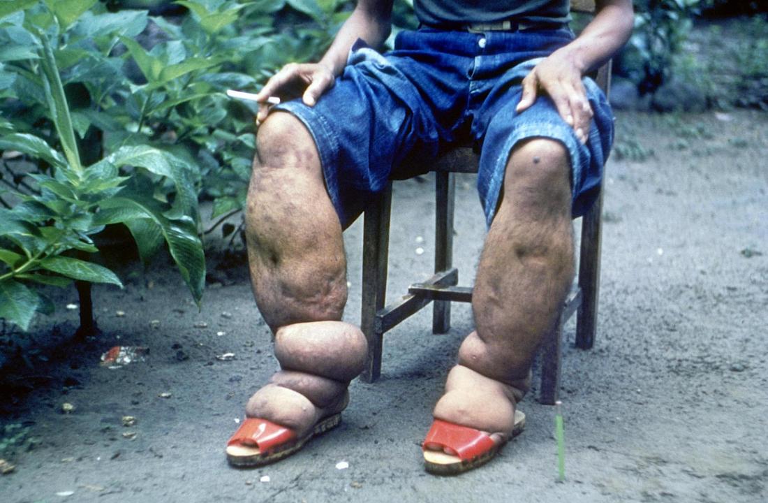 Elephantiasis (Elefantiasis): Ursachen, Symptome, Behandlung, Prognose
