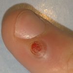 Pyogenes Granulom: Was ist das, Symptome, Behandlung, Prognose?