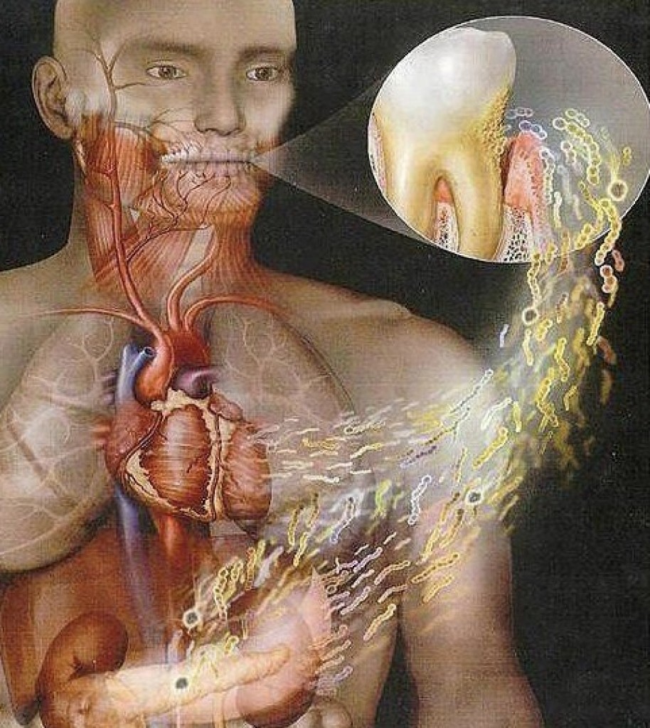 Endocarditis: que es, síntomas y tratamiento en adultos