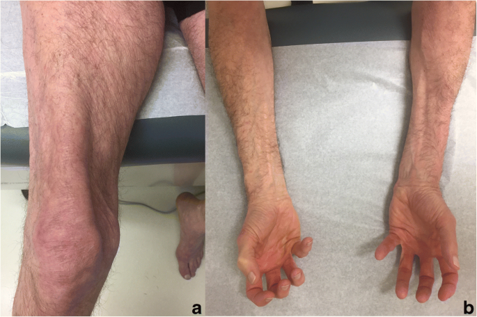 Polymyositis: Was ist diese Krankheit, Symptome, Behandlung, Prognose?