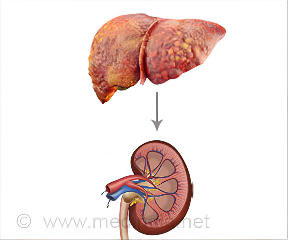 Hepatorenales Syndrom: Was ist das, Symptome, Behandlung, Prognose