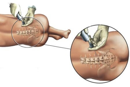 Anæstesi under kirurgiske procedurer
