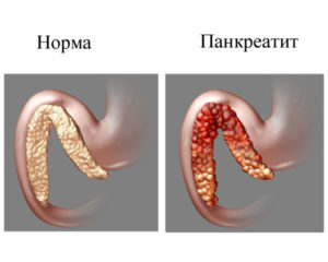 Sygdom pancreatitis