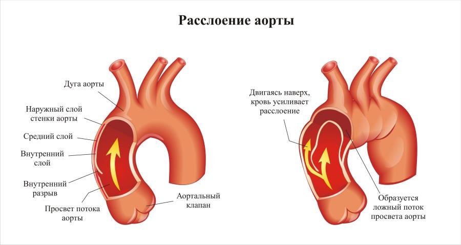 Aortální pitvy: Příznaky a First Aid