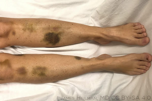 Thrombotische thrombozytopenische Purpura: Was ist das, Symptome, Behandlung, Prognose