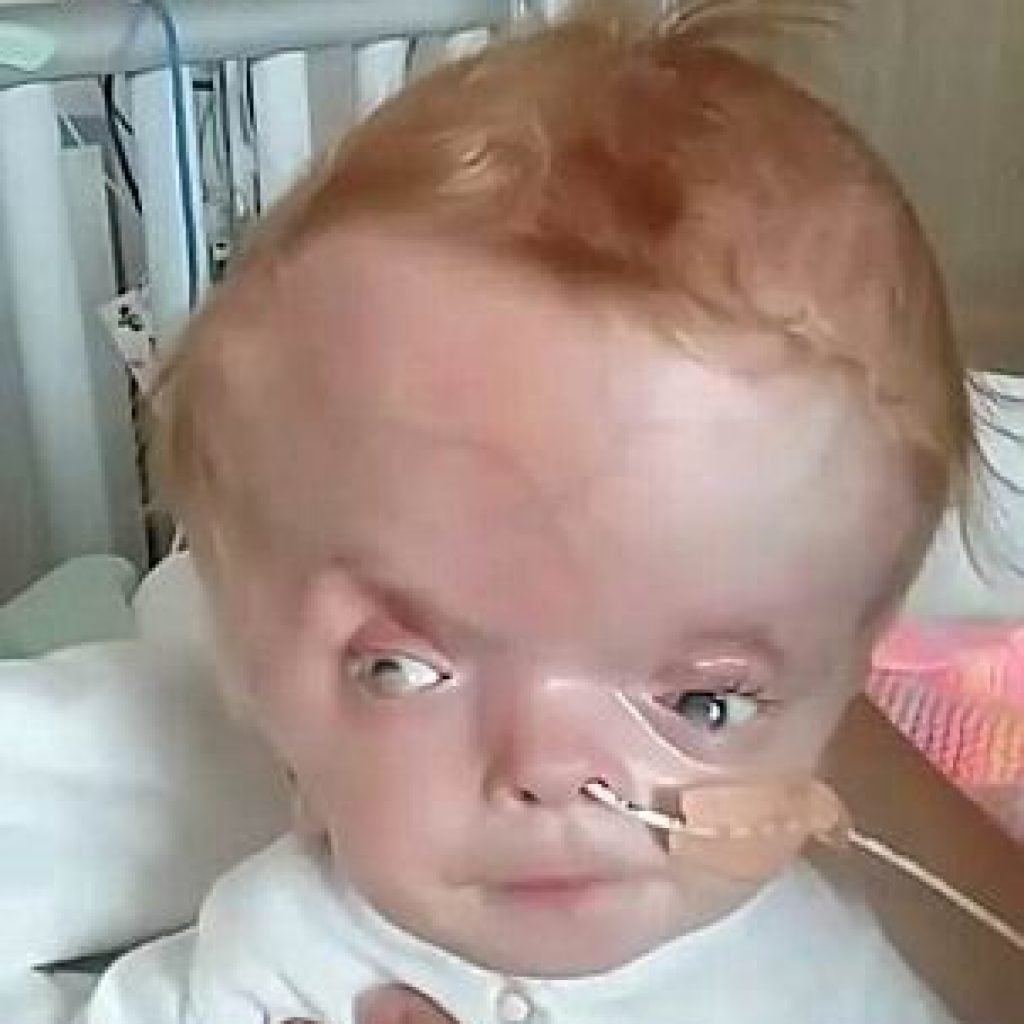 Syndrom Dandy Walkera u dětí: co to je, příčiny, příznaky