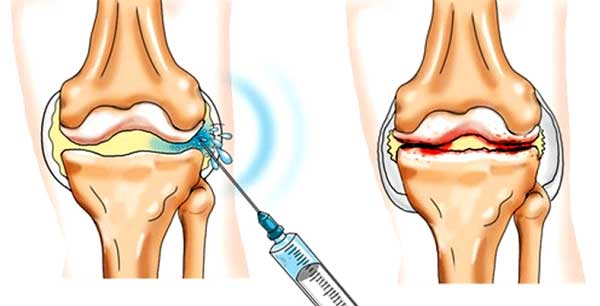 Osteomyelitida - příznaky, příčiny, léčba