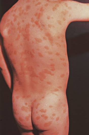Mastocytose: wat is het, oorzaken, symptomen, behandeling, prognose