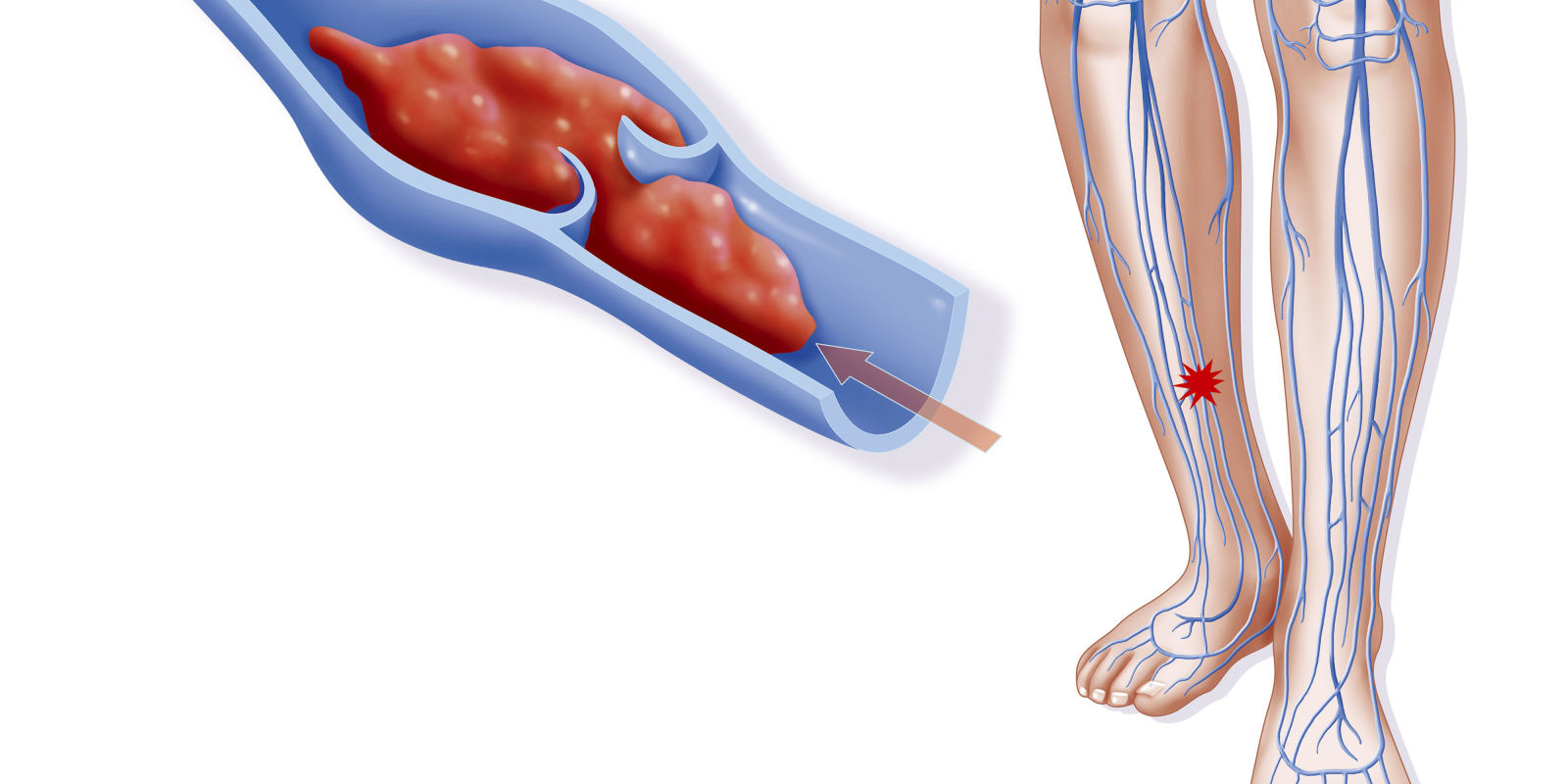 Thrombosis of the lower extremities: symptoms, photos and treatment