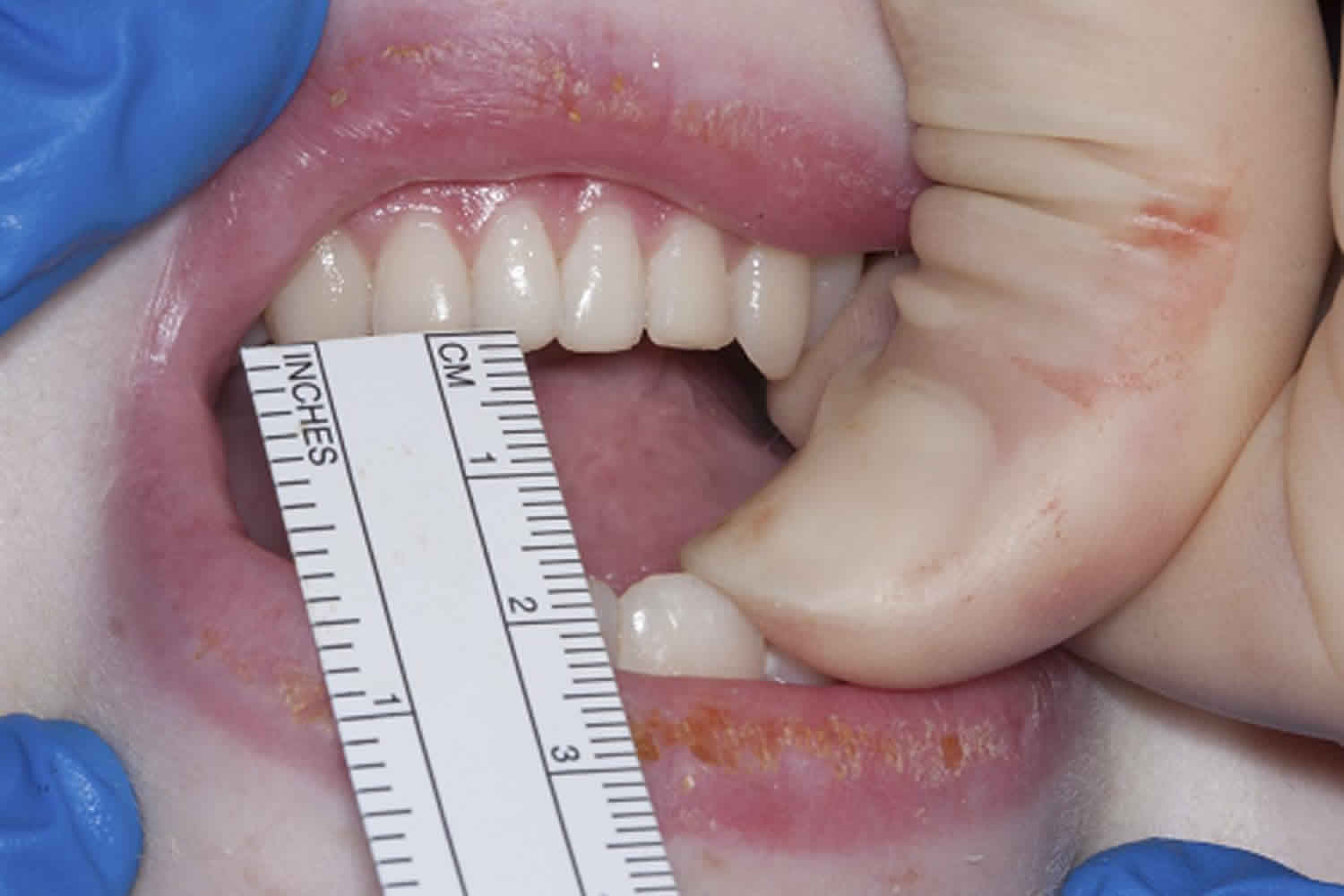 Trismus: Was ist das, Ursachen, Symptome, Behandlung, Prognose
