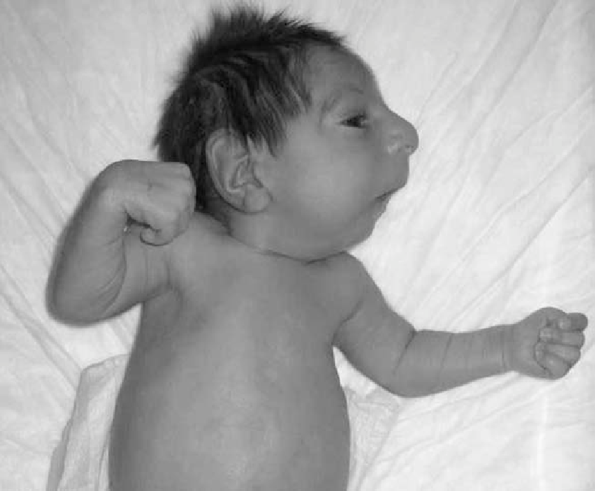 Seckel-Syndrom: Was ist das, Ursachen, Symptome, Behandlung, Prognose