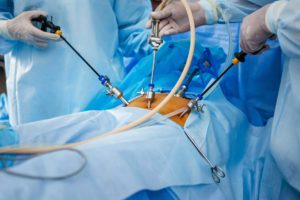 La laparoscopia è indicata per l'appendicite