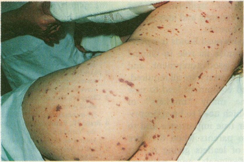 Meningokokkenmeningitis: oorzaken, symptomen, behandeling, prognose