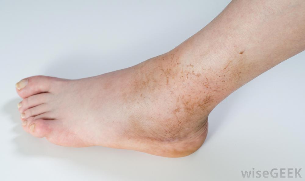 Osteomyelitis: wat is het, oorzaken, symptomen en behandeling, complicaties en prognose
