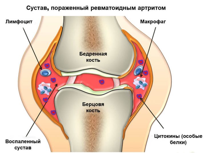 Arthritis und Arthrose: Was ist der Unterschied?