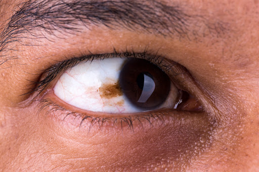 Melanoom van het oog: wat is het, symptomen, oorzaken, behandeling, prognose