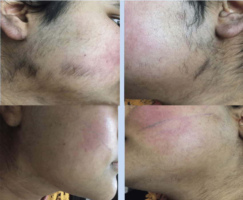 Hirsutismus: Was ist das, Symptome, Behandlung, Prognose