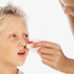 Nasal blødning hos børn