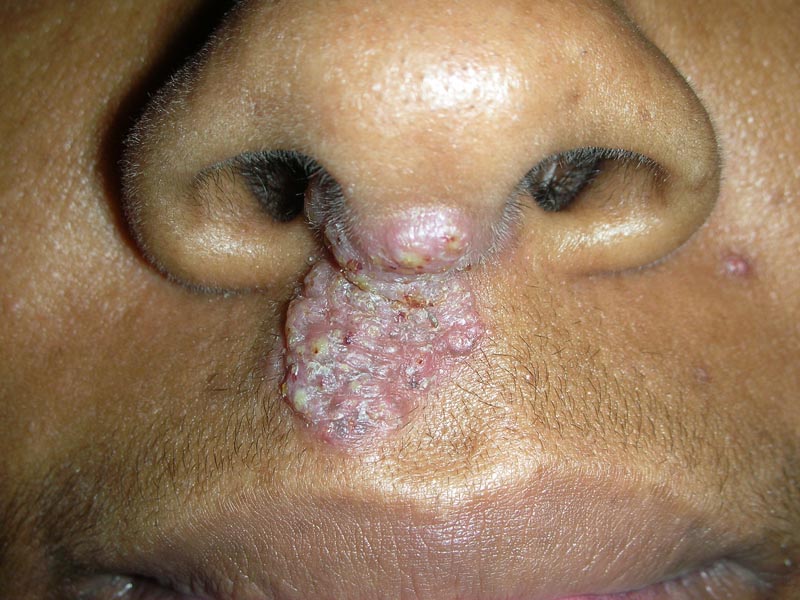 Blastomykose: Was ist das, Ursachen, Symptome, Behandlung, Prognose