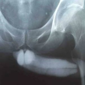 Cavernosographie: indications, l'exécution de la technique, le décodage